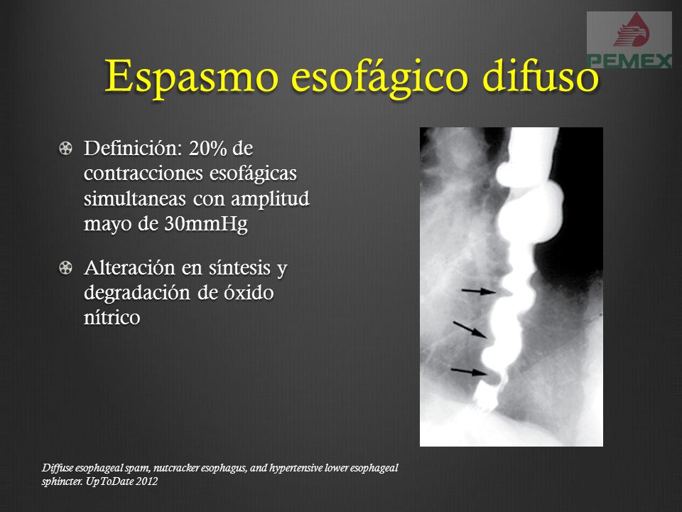 espasmo esofagico difuso